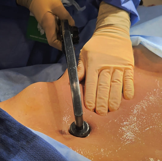 surgeon holding Bodytighten Ignite RF handpiece to melt abdominal fat and tighten the skin for body contouring surgery