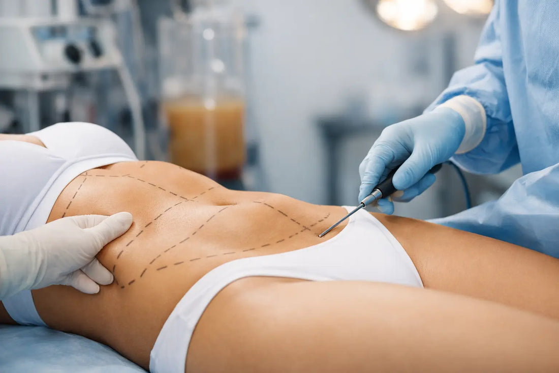 Liposuction for Stubborn Fat Explained