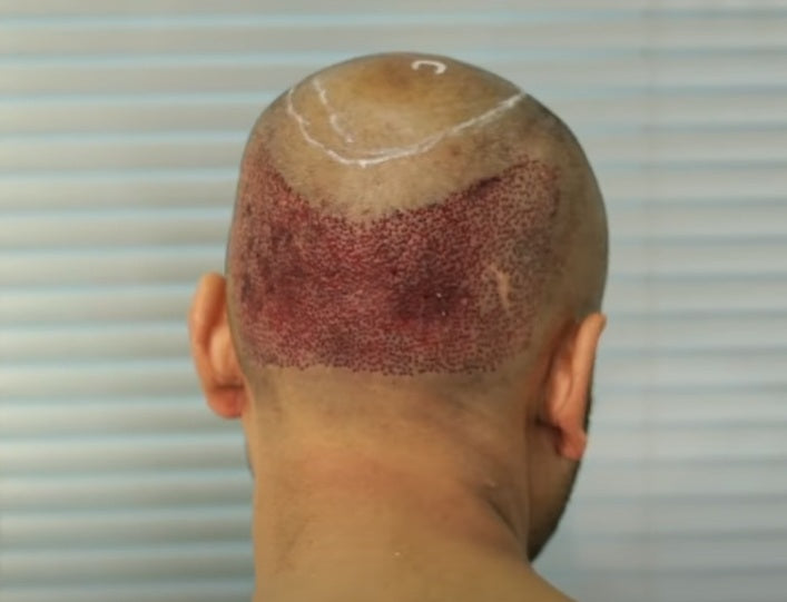 Revising Old Hair Transplant Scars