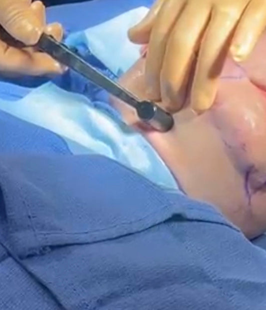 surgeon holding facetite ignite RF handpiece to tighten the neck