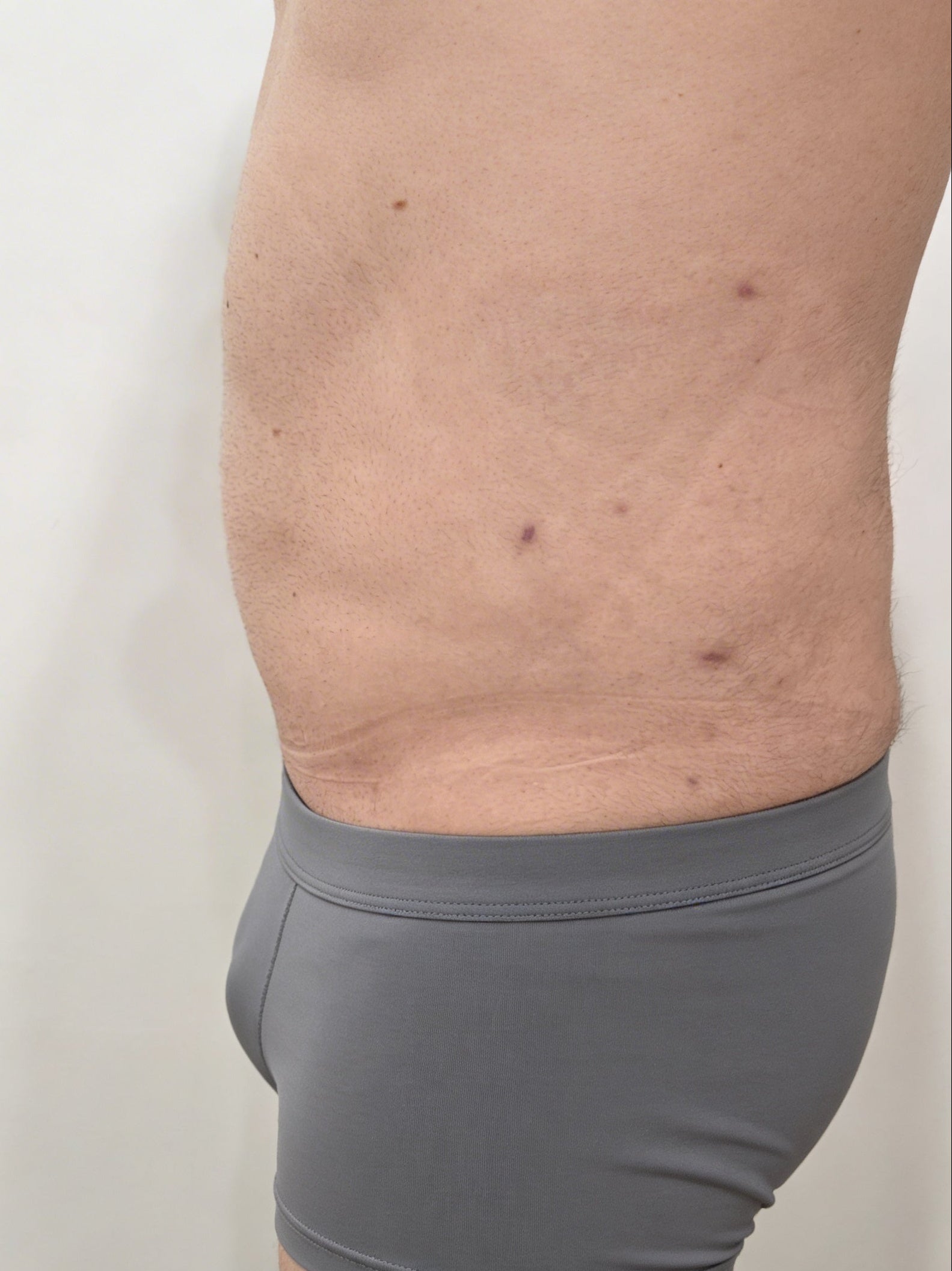 After liposuction (lateral view)