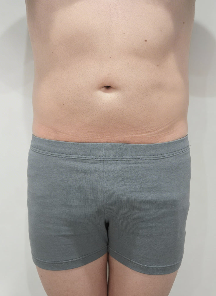 After liposuction (front view)