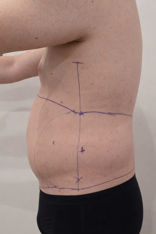 Before liposuction (lateral view)