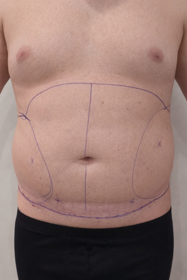 before liposuction (front view)
