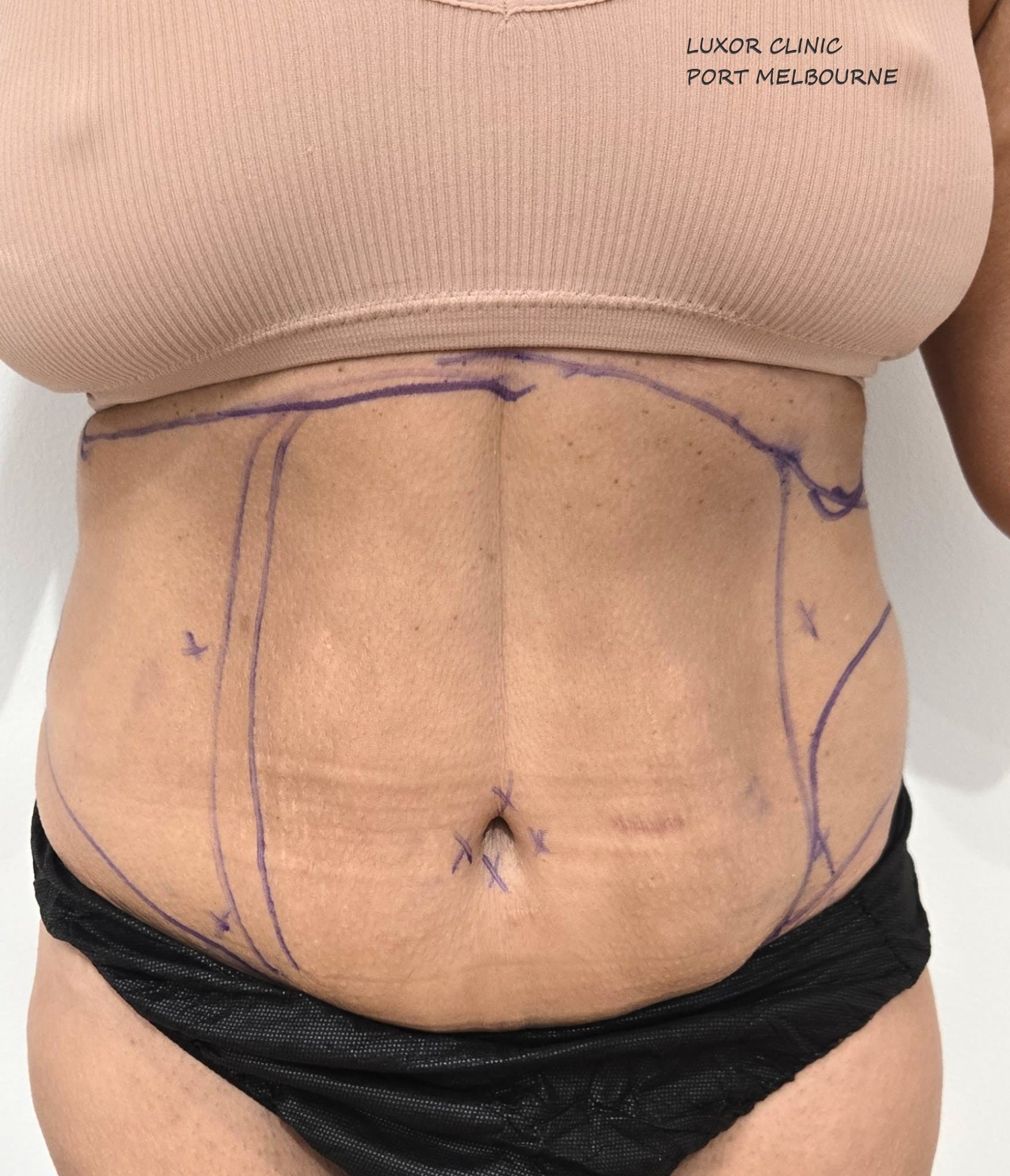 WOMAN ABDOMEN WITH SURGICAL MARKING BEFORE BODY CONTOURING SURGERY AT LUXOR CLINIC IN PORT MELBOURNE