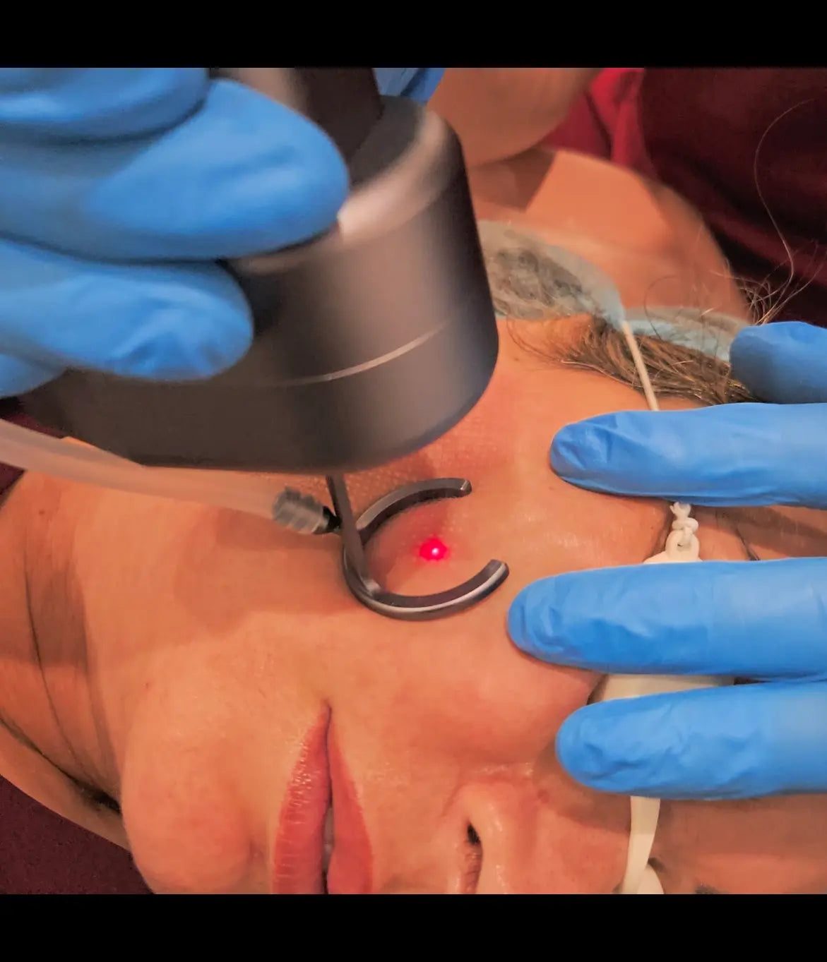 doctor using CO2 laser on woman's face