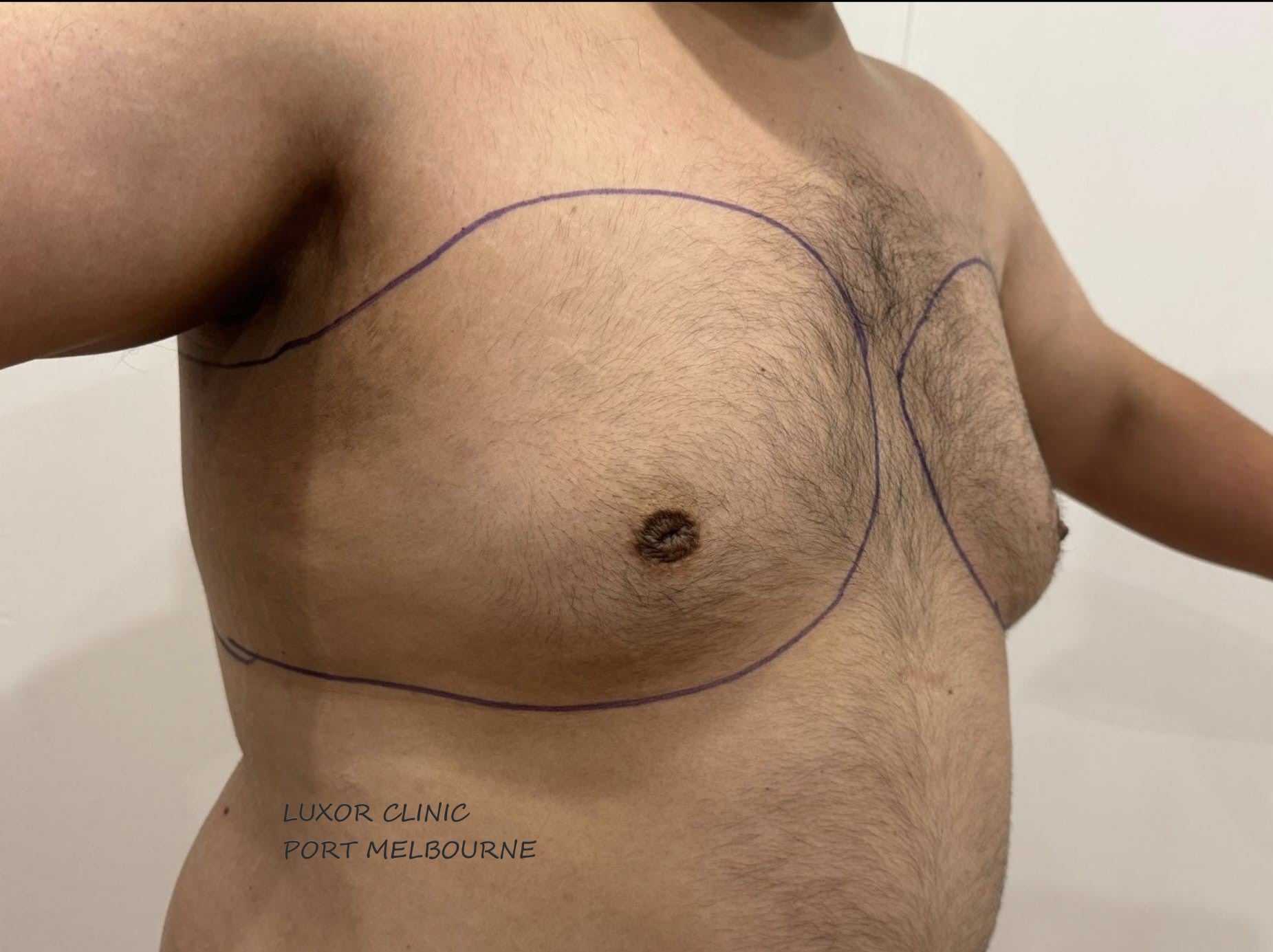 MAN WITH ENRALGED BREAST, GYNAECOMASTIA AND SURGICAL MARKING BEFORE GYNAECOMASTIA REDUCTION SURGERY AT LUXOR CLINIC