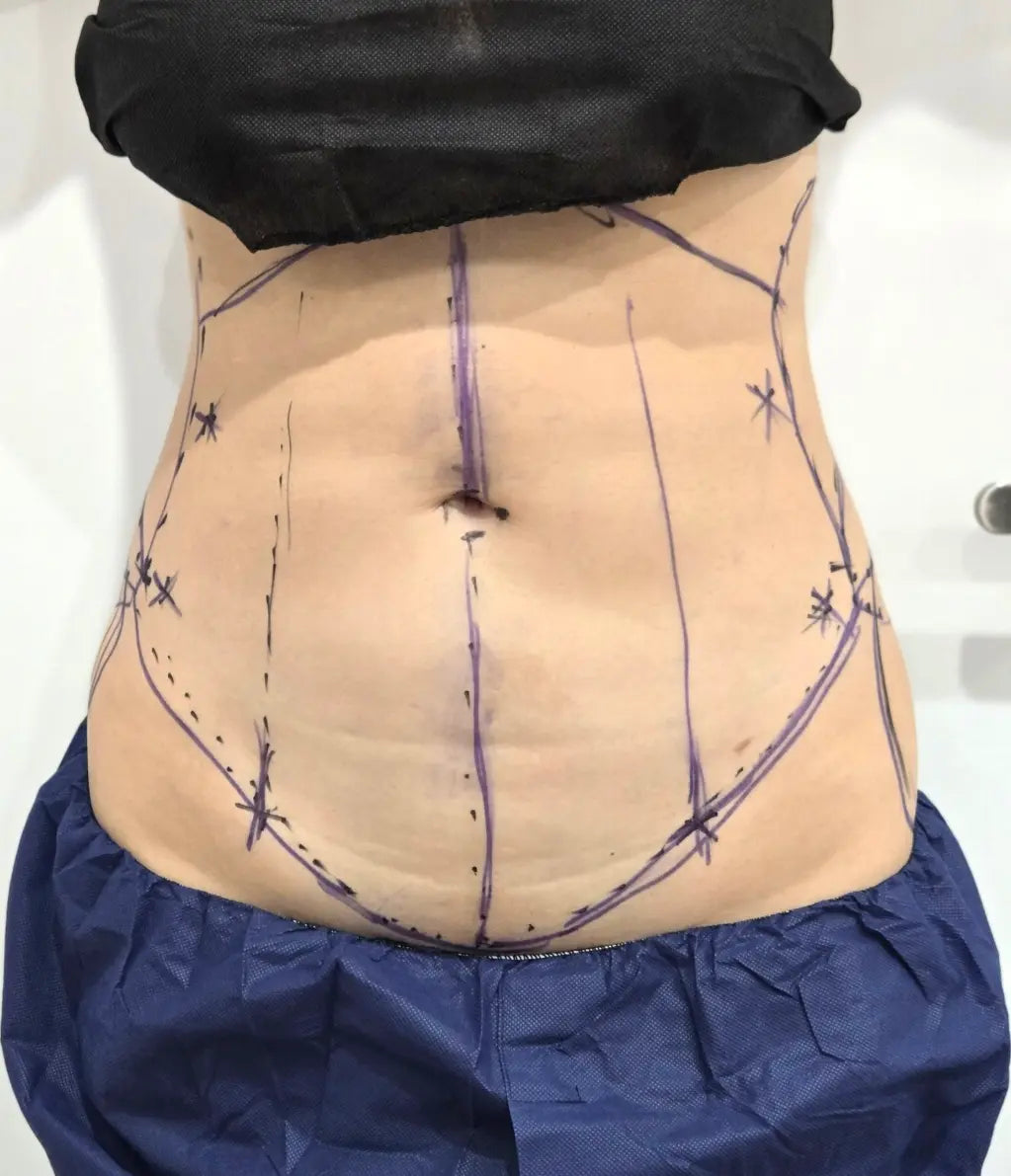 women's abdomen with surgical markings for liposuction