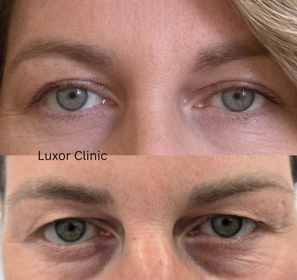 Before and after comparison of upper blepharoplasty treatment by Luxor Clinic