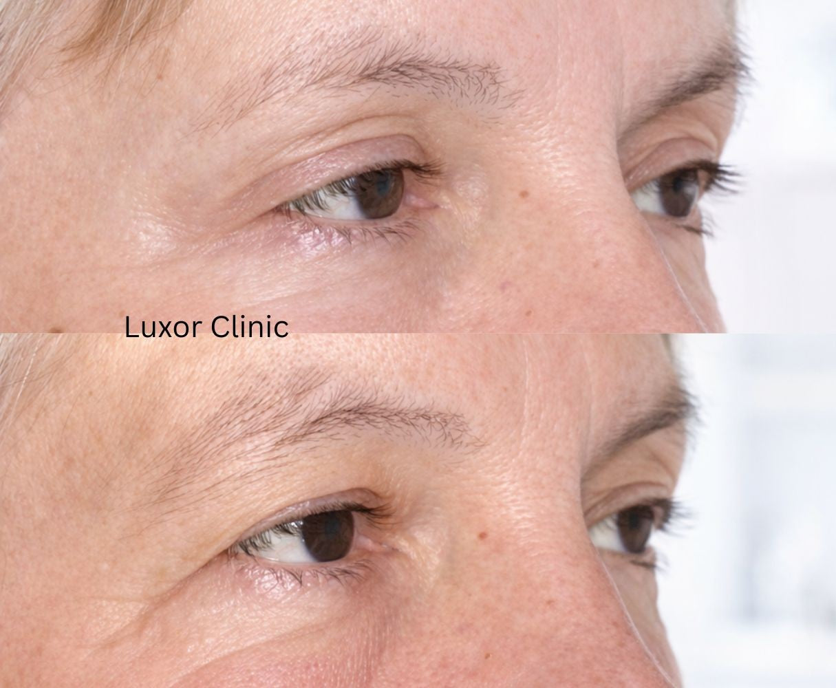 Before-and-after comparison of a person's eye area treatment, blepharoplasty, with Luxor Clinic branding.