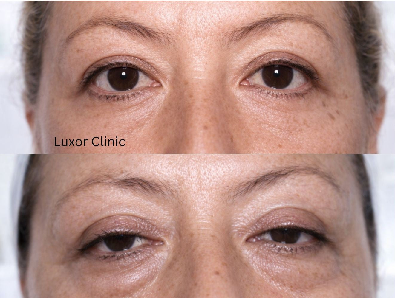 Before and after comparison of eye area treatment, blepharoplasty by Luxor Clinic