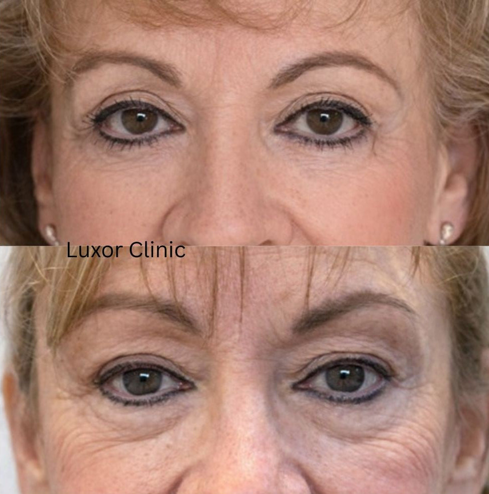 Before-and-after comparison of a woman's face after blepharoplasty at Luxor Clinic.