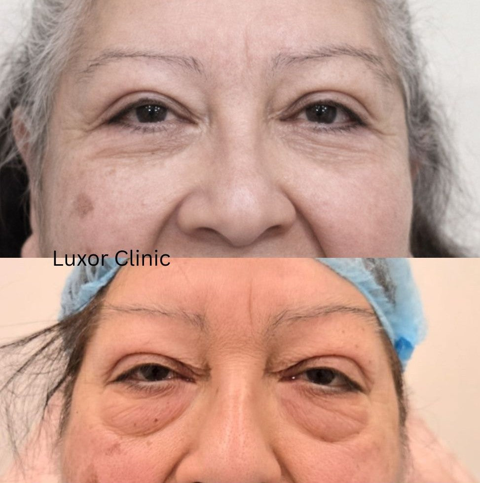 Before and after comparison of a woman's face after upper and lower blepharoplasty with 'Luxor Clinic' branding.