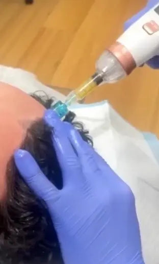 doctor injecting PRP on scalp for hair regrowth