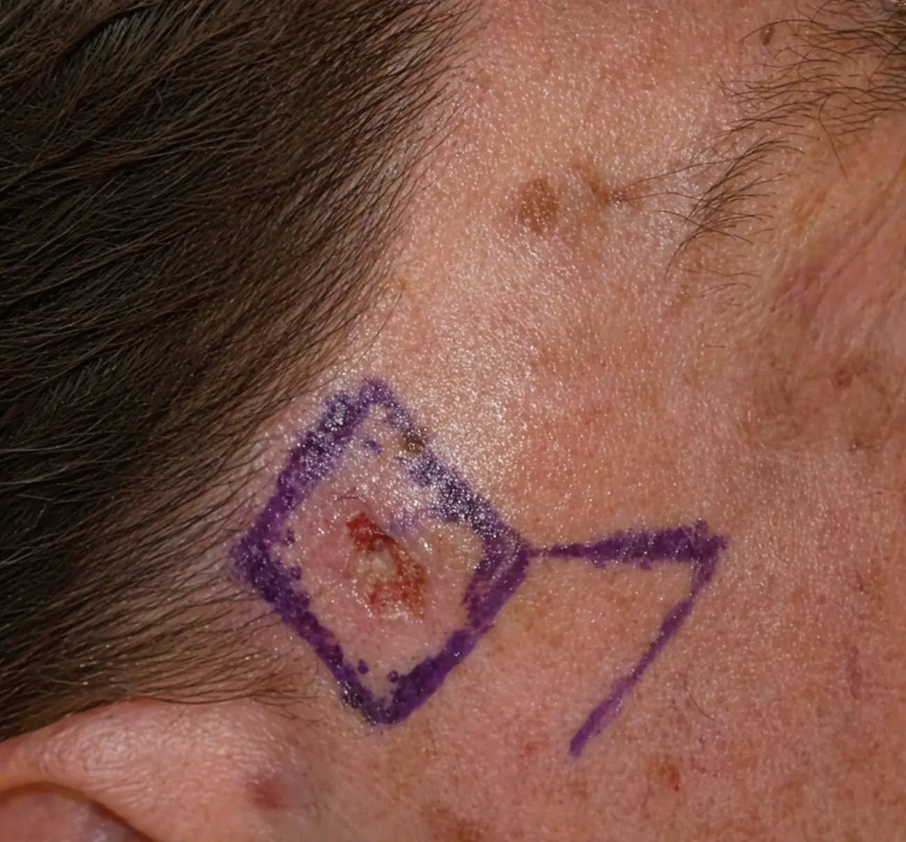 Skin with a purple border around a mole or skin cancer, likely for surgical marking.