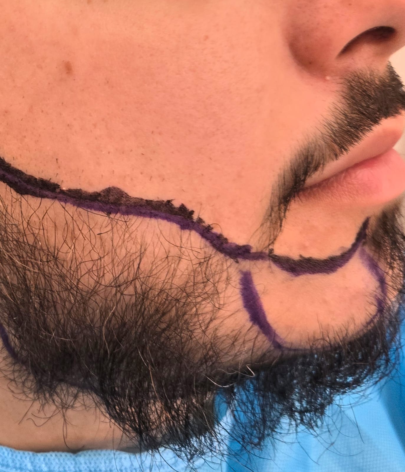 Close-up of a person's beard area with surgical marking for beard transplant