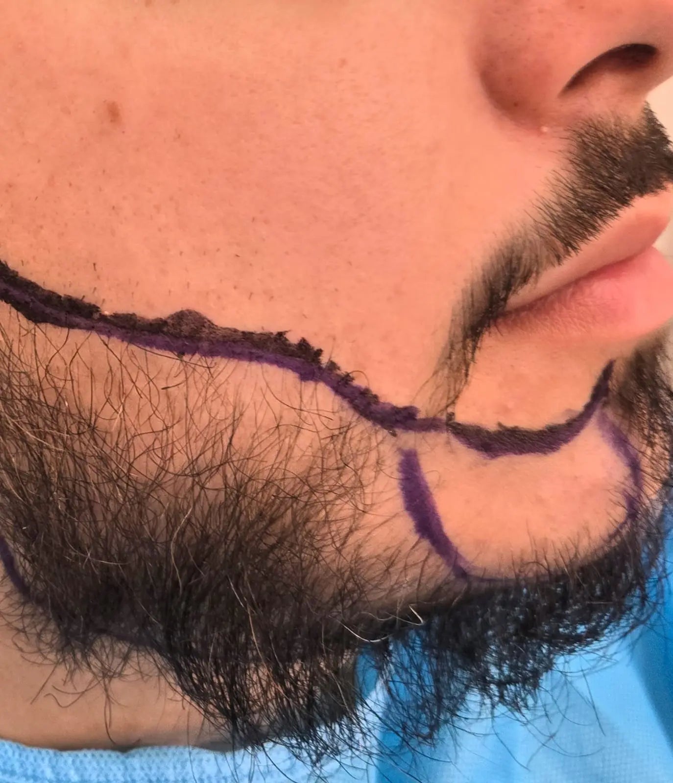 Close-up of a person's beard area with surgical marking for beard transplant