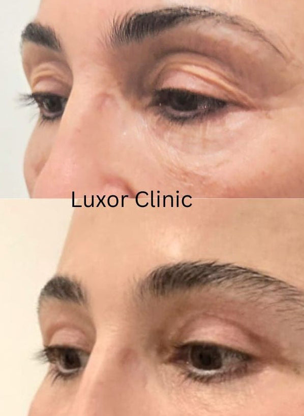 Before and after comparison of eyelid lift, blepharoplasty, treatment with 'Luxor Clinic' branding.