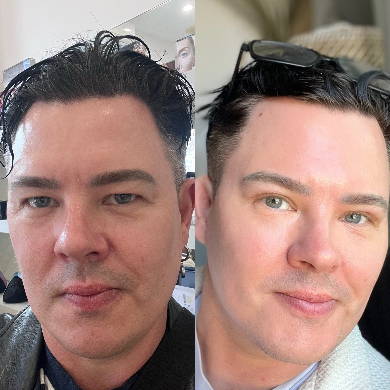 Side-by-side comparison of a man before and after upper blepharoplasty