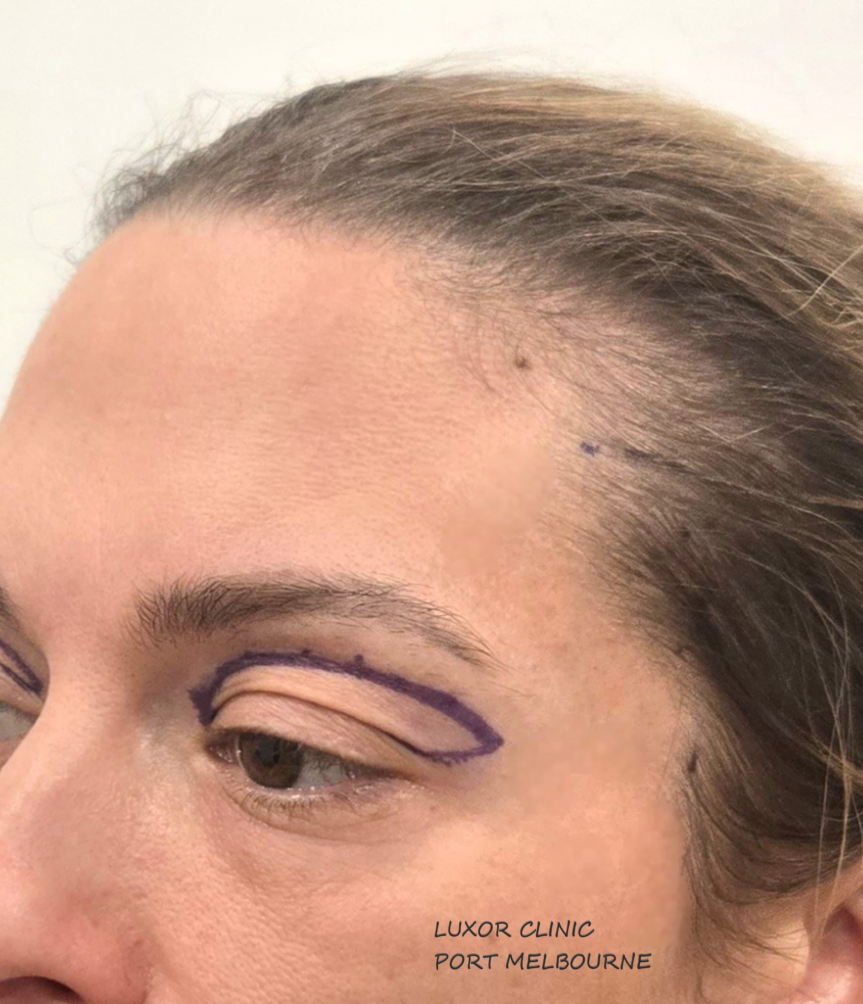 Close-up of a person's face with a Blepharoplasty surgical marker, Luxor Clinic Port Melbourne.