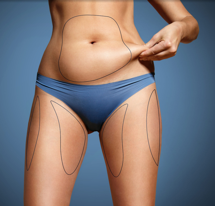 body with areas marked for liposuction