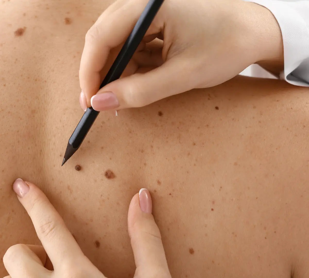 Person marking a mole on the skin skin on a close-up of skin surface.