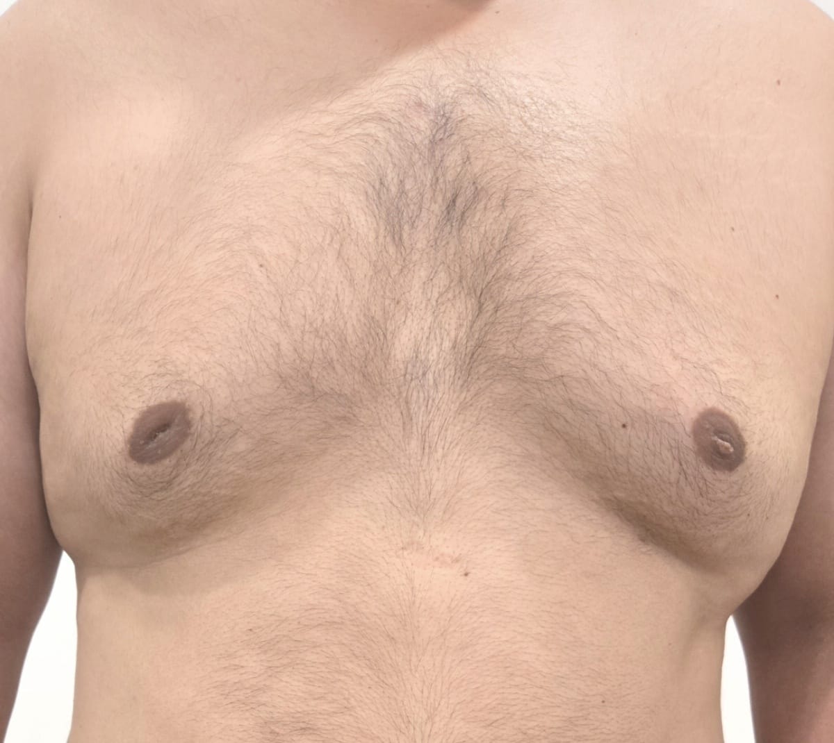 Partial view of a person's chest with large breasts (gynaecomastia)