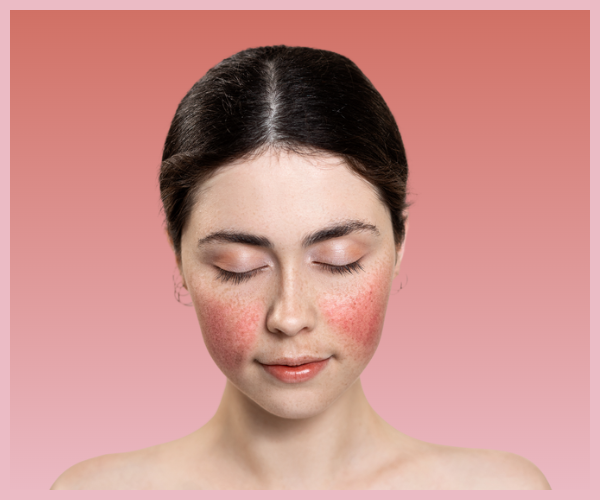 Sensitive Skin & Rosacea Facial